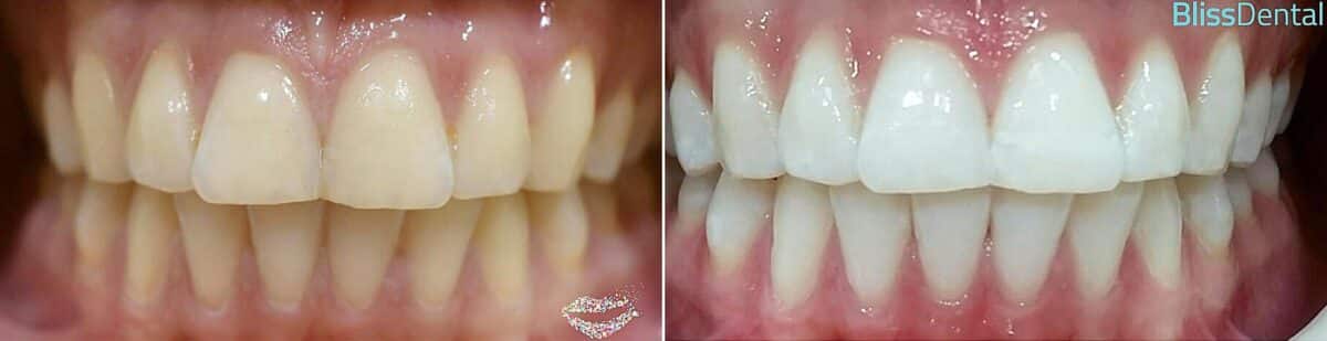 Smile Makeover Before and After Photos in Kendall, FL, Patient 176