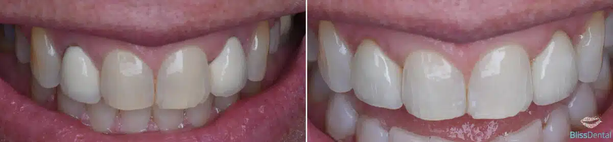 Dental Crowns Before and After Photos in Kendall, FL, Patient 2527