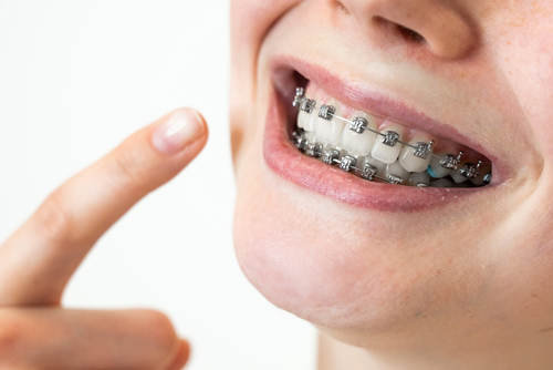 The Benefits Of Braces: More Than Just A Straighter Smile