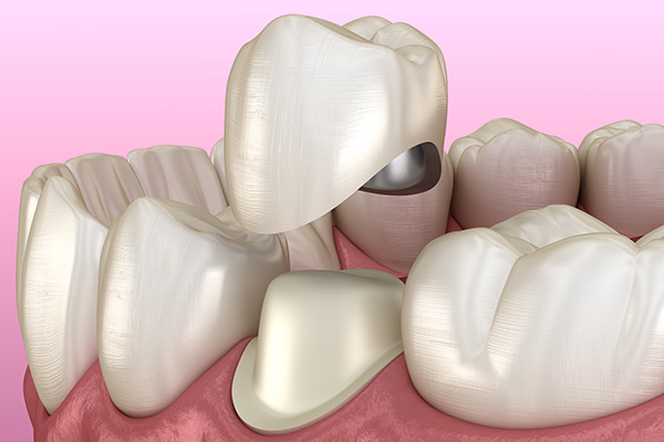 Options For Dental Crown Material From A General Dentist