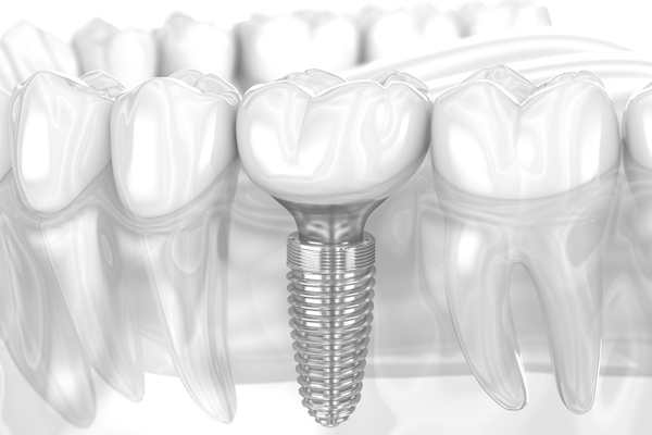 How Long Do Dental Implants Really Last?