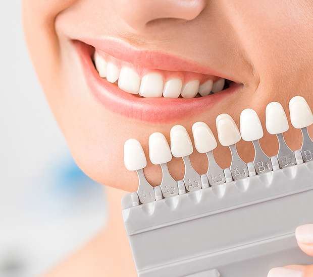 Kendall Veneers