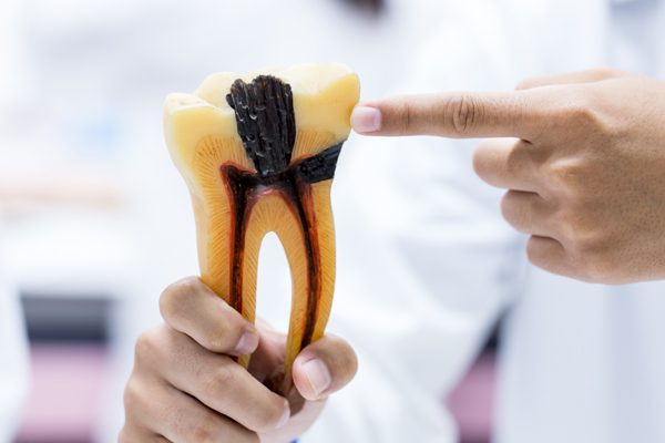 A Step By Step Guide To The Root Canal Procedure